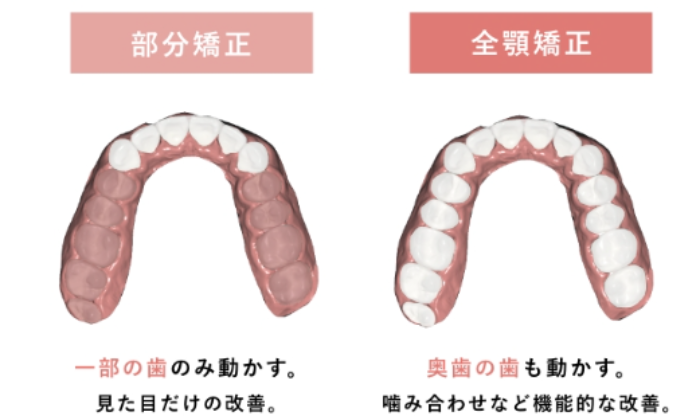 ディパール矯正